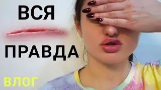 УВЕЛИЧИЛИСЬ губы 💋 Почему я не целуюсь ❓❗ Влог 