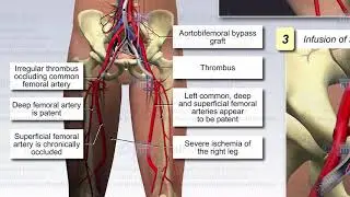 Peripheral Vascular Disease