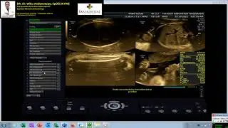 HEMANGIOMA NASAL - TUMOR PEMBULUH DARAH PADA WAJAH JANIN (Dr Wiku Andonotopo)