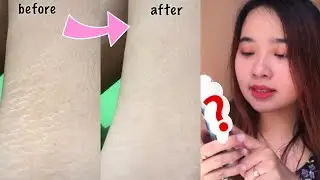TERBUKTI! CARA MENGHILANGKAN STRETCHMARK TANPA LASER! (REAL PENGALAMAN PRIBADI)