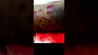 Sucking Chest Wound After Pitbull Attack
