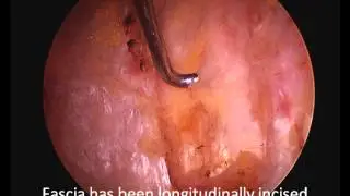 Arthroscopic hip bursectomy - Narrated surgical video