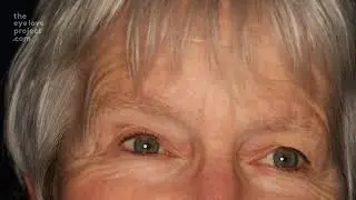 The Eye Love Project - Vision after cataract surgery