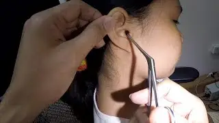 There's Something STUCK in Girl's Ear | Watch How It's Removed