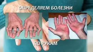 ОПРЕДЕЛЯЕМ БОЛЕЗНИ ПО РУКАМ
