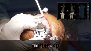Attune(Depuy synthes) with Brainlab Knee 3 Naturally Aligned Total Knee Replacement