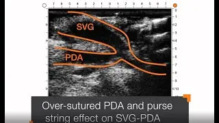 REQUEST Case 11: Ultrasound imaging of anastomosis