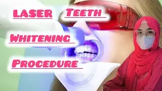 laser teeth whitening procedure ❗