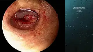 SINGLE HANDED ENDOSCOPIC EAR SURGERY EPITYMPANIC CHOLESTEATOMA