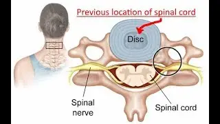 MAJOR changes to Human Vertebrae and Neck Arteries Mandela Effects