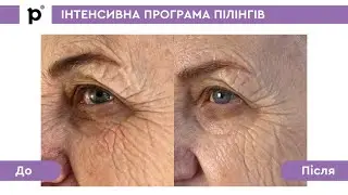 Інтенсивна програма пілінгів. Курс процедур Jessnerpeel з TCA&Glicopeel (3 процедури)