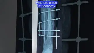 Fracture non union after operation, Economic model with minimal hospital stay and promising result.