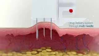 V2 Beauty Booster Treatment at Laser Skin Clinic Toronto
