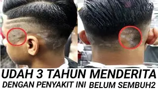 WASPADA Penyebab awal timbul nya penyakit PSORIASIS pada kulit kepala.