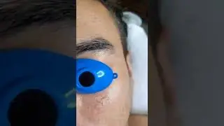 Blackheads #blackheadsremoval #skincareroutine #blackheadsremove #skincare