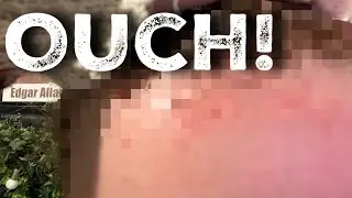 Vlog: I gave myself a CHEMICAL BURN!