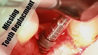 Dental Implant Process Step By Step in Less Than Two Minutes