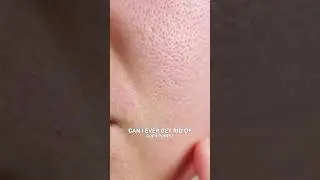 Read Pinned comment for the hero ingredient 🌸✨ #shorts #yt #shortsfeed #acne #openpores #finelines