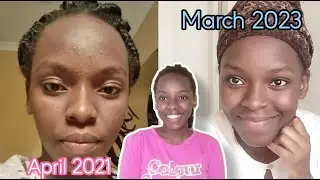 How I cleared my acne using a cap 🧢😳🤯|No cap🤣🤣😂😂|crazy,raw and candid🤭|face glow forever😍🤯