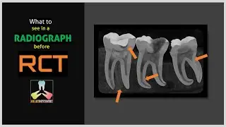What to see in a radiograph before RCT