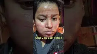 I TRIED THE ORDINARY PEELING SOLUTION 