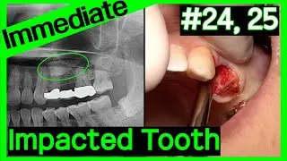 [Online Surgery] Impacted tooth vs  Implant