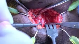 Thyroid cartilage reduction/Adam’s apple reduction/tracheal shave/chondrolaryngoplasty