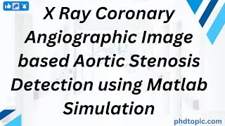 X Ray Coronary Angiographic Image based Aortic Stenosis Detection using Matlab Simulation