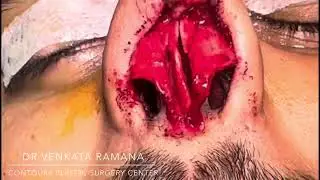Rhinoplasty Surgery for Nose tip deviation