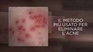 BRUFOLI CON ACNE