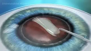 Linsenaustausch Monofokal CLE I Eyelaser Wien & Zürich