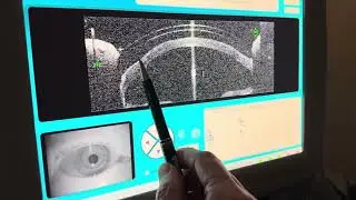 Using Optical Coherence Tomography To Look At A Scleral Lens Over An Eye With A Transplanted Cornea