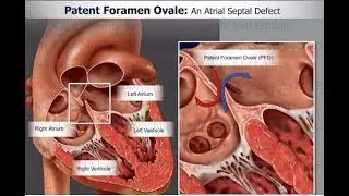 Patent foramen ovale (PFO) Part II