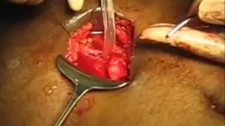 Open Cystolithotomy   YouTube