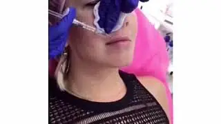 Увеличение губ в клинике Аура