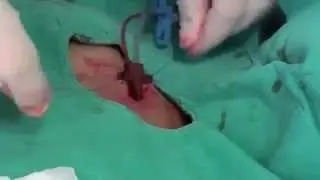Subclavian Catheter