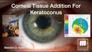 Corneal Tissue Addition For Keratoconus (CTAK)