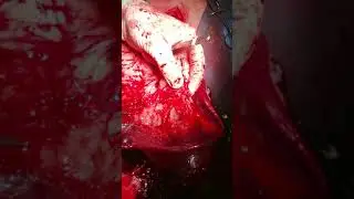 splenic tumor case