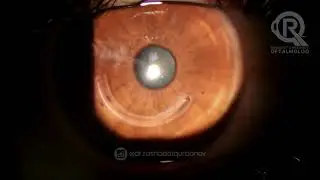 Keratokonus - Stromal halqa (corneal ring) - Oftalmoloq Dr. Rəşadət Qurbanov.