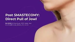 Lateral Platysmal Contouring by Dr Daniel Mills