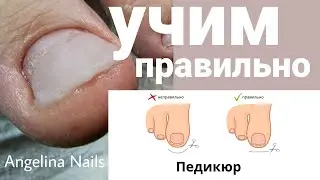 ВРАСТАЕТ НОГОТЬ / учим правильно подстригать / протезирование акрилом / педикюр подростку