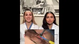 Lower Eyelid Bags and Circles with Sam & Meg