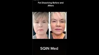 FAT DISSOLVING @sqinmed6152 #fatdissolvinginjections #fatdissolving #liposuction #sqinmed