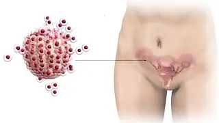 ⛔ LES INFECTION VAGINALE QUI CAUSE L'INFERTILITÉ / DOCTEUR PAULO LUTUMBA