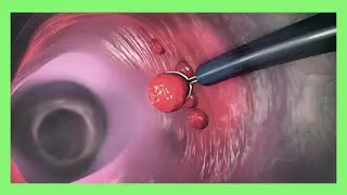 Полипэктомия желудка / Gastric Polypectomy. Видео урок . WORLD MEDICINE