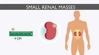 Active Surveillance for Kidney Cancer