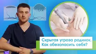 Пугающие родинки и другие новообразования. Как сделать свою жизнь безопасной и исключить рак?