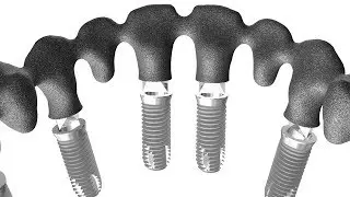Kwan Implant Restoration