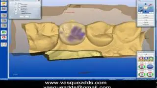 Cerec AC  e.max LT for Implant Restoration