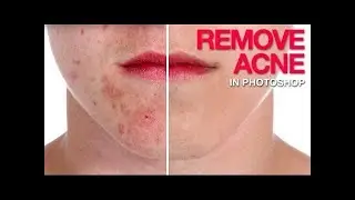 HOW REMOVE PIMPLES ON PHOTOSHOP CC 2017